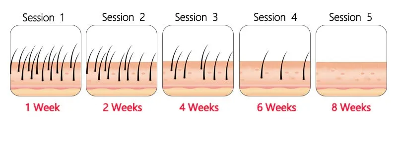At Home Laser Hair Removal Permanent Hair Removal Device
